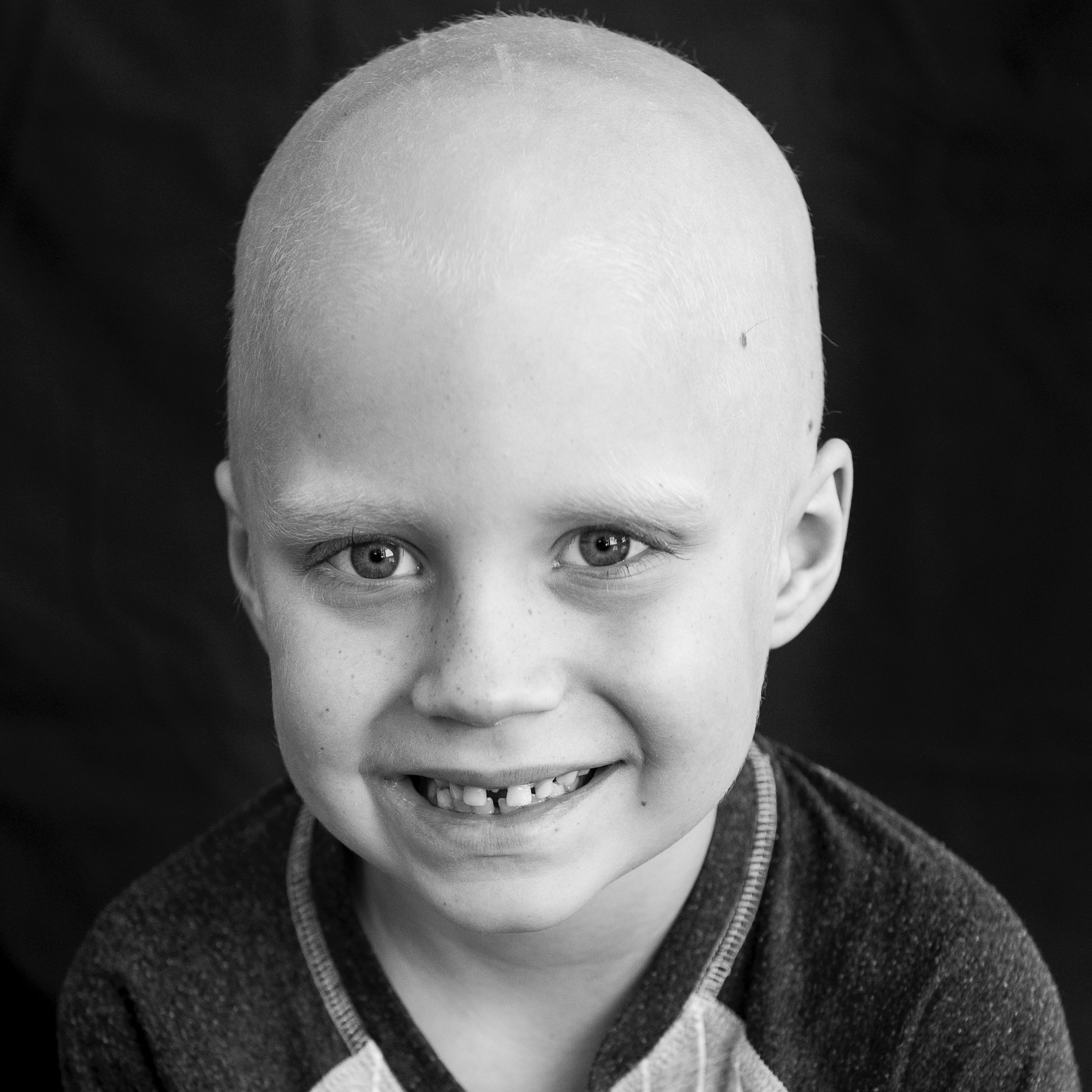 Delayed Intensification Pediatric Leukemia: side effects, symptoms, endurance